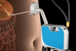 Temuan Baru: Alat Penurun Berat Badan dengan Metode Membuang Isi Perut 