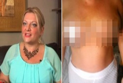 Kisah-kisah Permak Payudara yang Gagal: Puting Lepas dan Membusuk