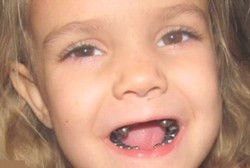 Maksud Hati Menambal Gigi, Seluruh Gigi Malah Berubah Jadi Logam