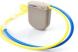 Terobosan Baru: Implan Ditanam di Kulit untuk Pengobatan Kanker Ovarium 