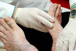 Hal-hal Ini Turunkan Risiko Amputasi pada Pasien Diabetes Hingga 50%