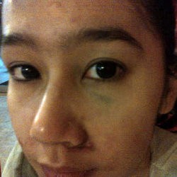 Nih! Bukti Foto Ardina Rasti Dianiaya Eza Gionino