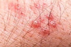 Infeksi MRSA, Penyakit Kulit Akibat Infeksi Bakteri Staph