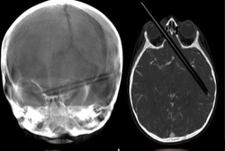 Bruk! Jatuh dari Kursi, Bocah Ini Tertusuk Pensil di Matanya