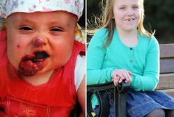 Tumor Sebesar Bola Tenis di Mulut Diangkat, Lottie Bisa Senyum Lagi