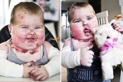 Kulit Sangat Rapuh, Bayi Ini Bisa Meninggal Hanya karena Benjolan Kecil