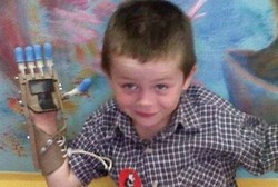 Terlahir Tanpa Jari di Tangan Kanan, Kini Balita Ini Bertangan Robot