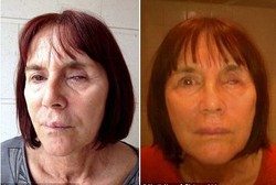 Mata Buta karena Kornea Dimakan Jamur dari Lensa Kontak