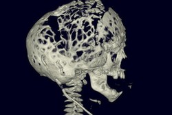 Bocah 2 Tahun Ini Lahir dengan Tengkorak Bolong-bolong Seperti Keju