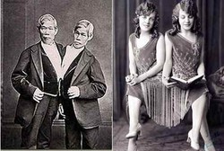 Inilah Kembar Siam Paling Terkenal di Dunia