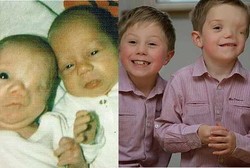 Kembar Tapi Tak Sama, Satu Bayi Lahir dengan Wajah Separuh