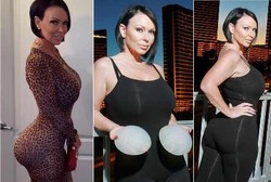 Bokong Renee Meledak karena Implan Silikon Terbalik