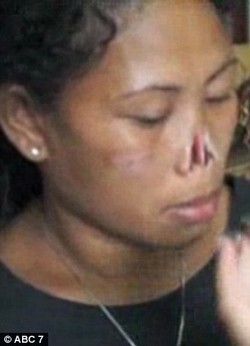 Hidung Ditebas Suami, Wanita Indonesia Dapat Hidung Palsu dari Peraih Oscar