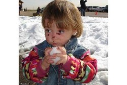 Kena Penyakit Langka, Gadis Kecil Ini Langsung Luka-luka Saat Disentuh