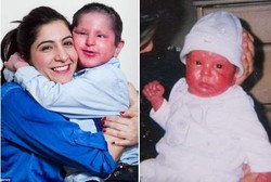 Kulit Bocah Ini Terbakar Tiap Hari karena Penyakit Langka