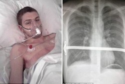 Tulang Rusuk Pria Ini Harus Dipasangi Logam karena Penyakit Langka