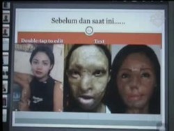 Korban Penyiraman Air Keras Jalani Operasi ke-17