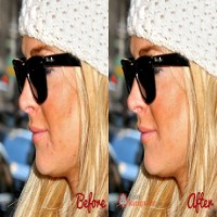 Cara Kilat Hapus Jerawat