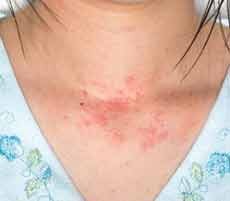 Muncul Bercak Tak Biasa di Kulit? Waspadai 4 Masalah Kulit Berbahaya Ini