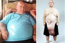 Berat Badan Sukses Turun 95 Kg, Tapi Kulit Perut Menggelambir Selutut