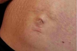 Unik! Ada Jejak Wajah Bayi di Perut Ibu Hamil Ini