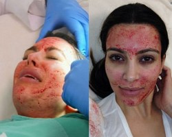Seram! Wajah Kim Kardashian Berlumur Darah Ketika Facial