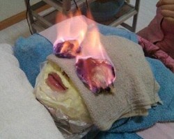 Seram! Metode Bakar Wajah Bisa Buat Anda Awet Muda