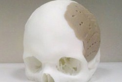 Keren! Pasien Ini Hidup dengan 75 Persen Tengkorak Buatan