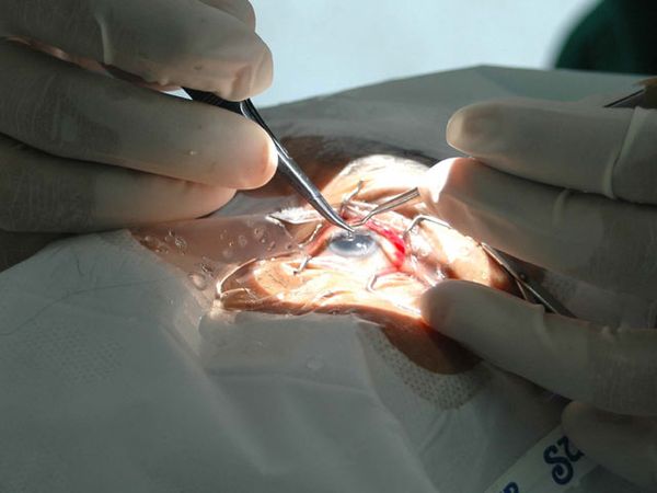 HUT Asperindo Operasi Katarak Gratis