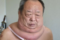 Karena Tumor, Leher Pria Ini Tumbuh Hampir Sebesar Bahunya