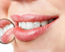 Memasang Berlian di Gigi, Aman atau Tidak?