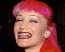 Hati-hati! Akibat Fatal Sembarangan Pasang Behel