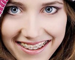 Jangan Jorok, Perhatikan Dos & Donts Saat Pakai Kawat Gigi