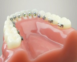  Ini Jenis Behel yang Tak Akan Membuat Mulut Anda Monyong