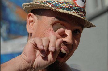 Lubang Besar di Wajah karena Tak Punya Bola Mata