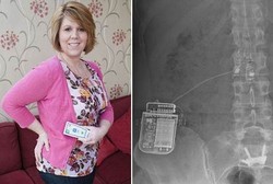 30 Tahun Tersiksa Sakit Punggung, Akhirnya Sembuh Berkat Remote Control