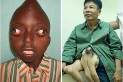 Orang-orang dengan Kelainan Bentuk Tubuh Paling Ekstrem