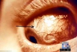 Gadis Ini Hampir Buta Karena Lensa Kontak