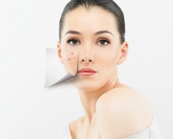 6 Mitos Keliru Tentang Jerawat yang Sering Dipercaya