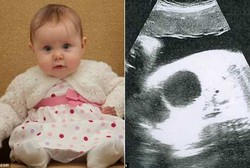 Belum Dilahirkan Tapi Bayi Ini Sudah Kena Kista Ovarium