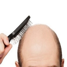 Pria Berkepala Botak Lebih Berisiko Kena Penyakit Jantung