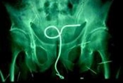 Karena Bosan, Pria 59 Tahun Masukkan Kawat ke Anusnya Sendiri