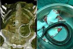 Terinspirasi Film Porno, Pria Masukkan Belut Hidup ke Anusnya