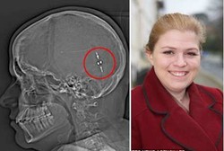 Sakit Kepala Parah, Wanita Ini Sembuh Setelah Minum Cairan Otaknya