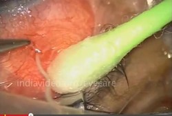 Perhatikan Baik-baik, Adakah Cacing di Mata Anda?