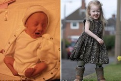 Gadis Kecil yang Lahir dengan Kaki Seperti Katak Ini Akhirnya Bisa Jalan