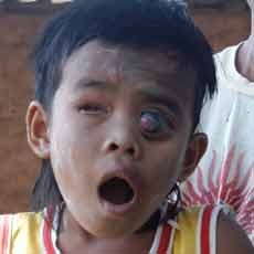 Bola Mata Rusak Keinginan Bocah Yasuli Masuk Sekolah Belum Kesampaian