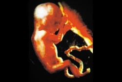 Buru-buru Potong Tali Pusat Bikin Bayi Berisiko Anemia dan Ganggu Otak