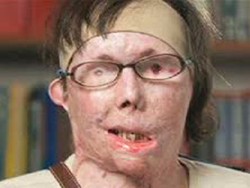 Korban Kekerasan, Ubah Wajah dengan Transplantasi