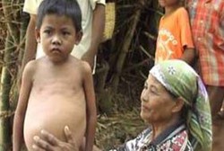 Perut Bocah 9 Tahun Ini Membesar karena Sirosis Hati